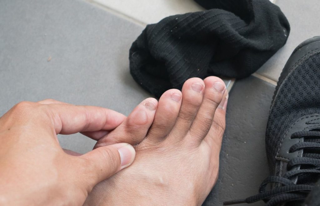 A blister on a mans little toe
