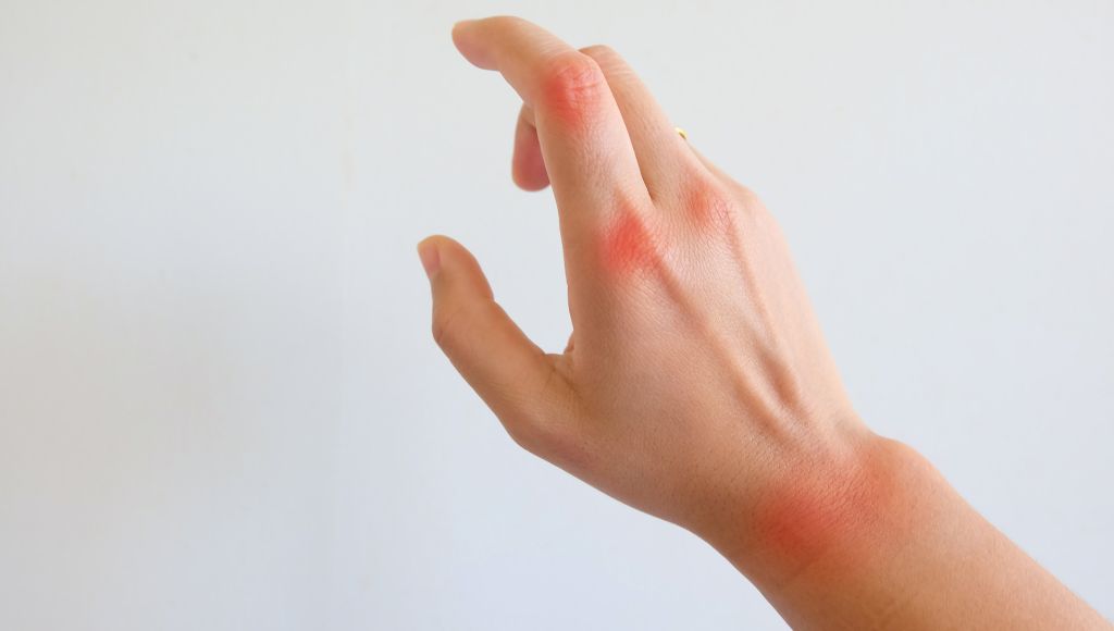 A rheumatoid arthritis syndrome hand